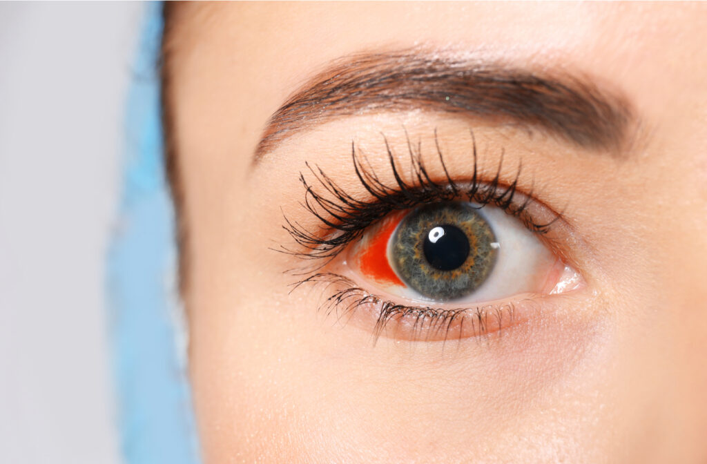 Women with broken blood vessel in eye which needs emergency visit to optometrist