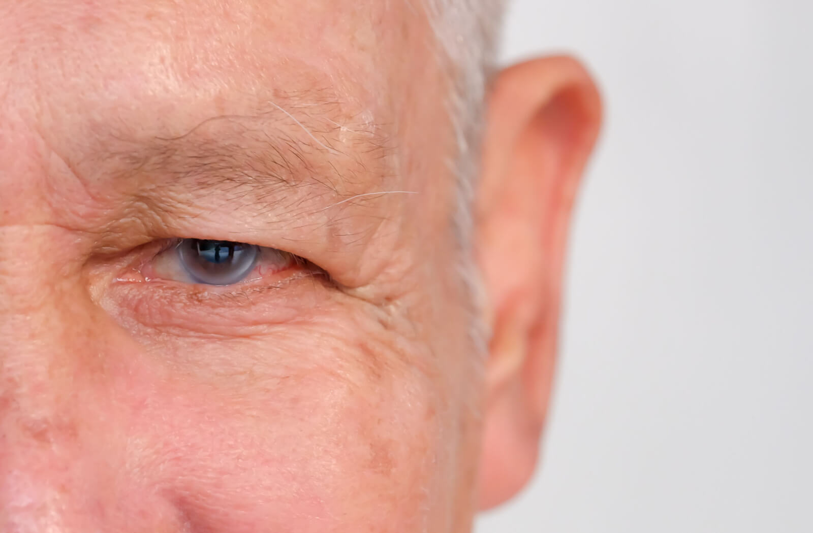 A close-up of an eye of a senior man with glaucoma.