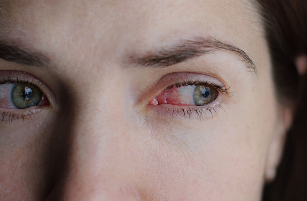 A close-up of a young woman with red dry eyes.