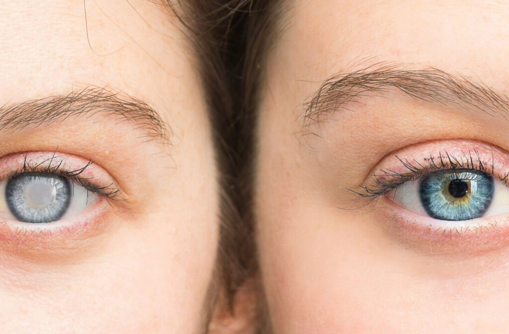 A close-up of two eyes. The eye in the left has cataracts and the one on the right is healthy