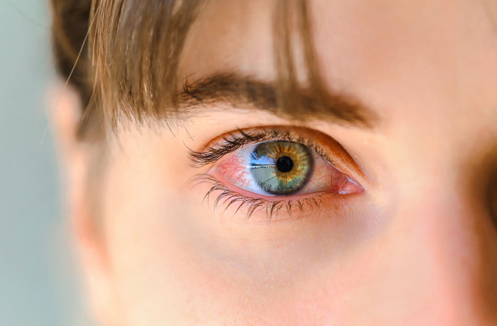 Close up of a young individual's hazel eyes experiencing conjunctivitis symptoms.
