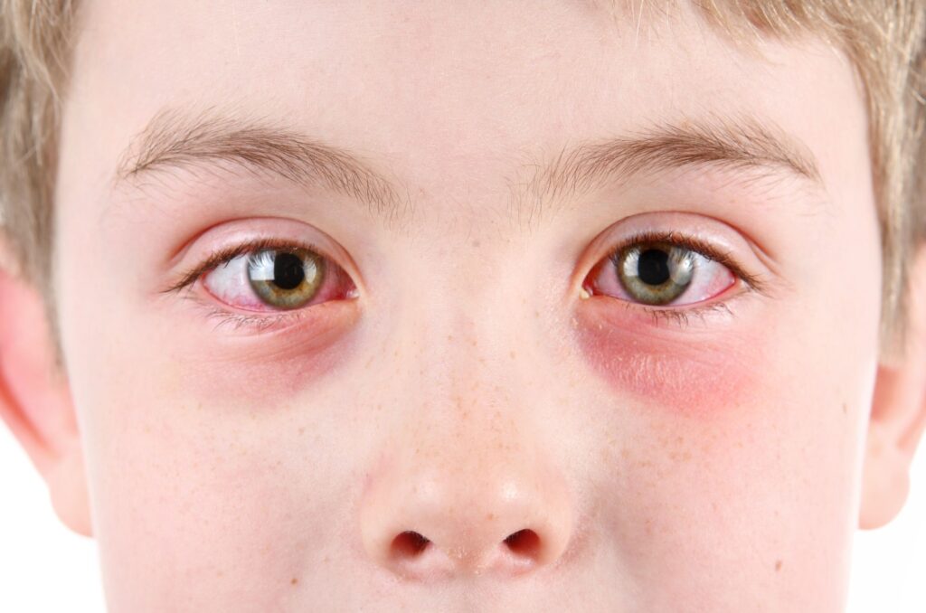 A close-up image of a child's face with pink eye in both eyes.