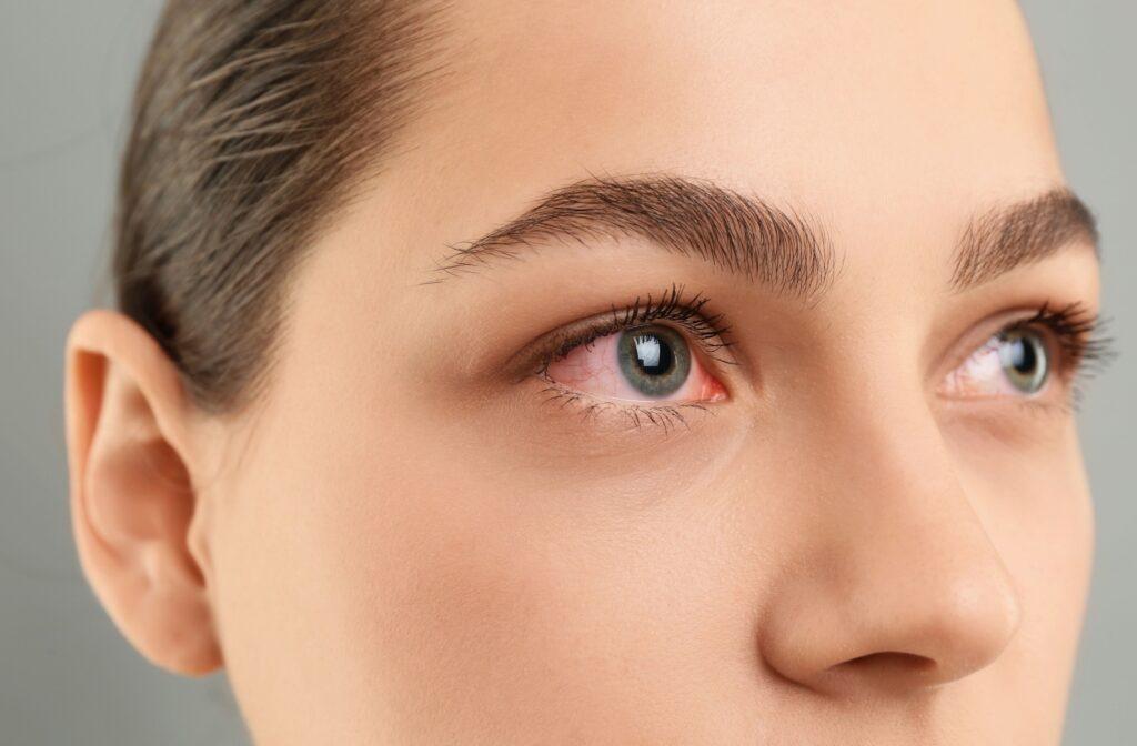 A close up of a persons eyes that are irritated and red due to allergies